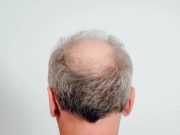 Mencegah Kebotakan: Tips Menjaga Kesehatan Rambut Anda Kebotakan Pria